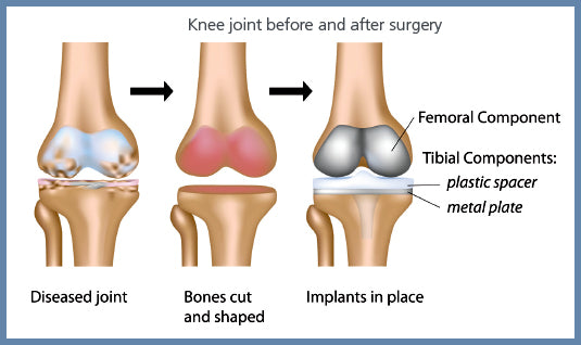 HKS Replacement Spacer